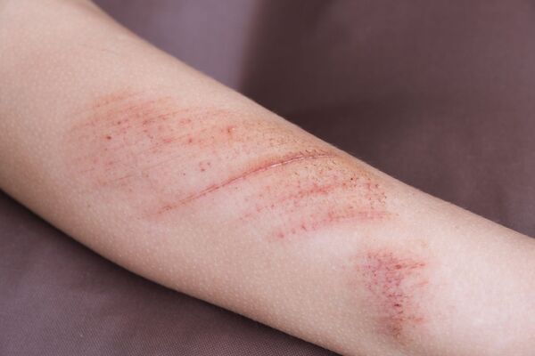 Dermatillomanie : quand le mal-être marque la peau